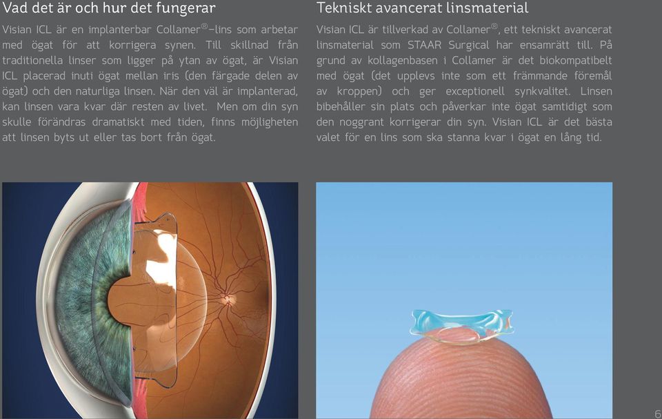 När den väl är implanterad, kan linsen vara kvar där resten av livet. Men om din syn skulle förändras dramatiskt med tiden, finns möjligheten att linsen byts ut eller tas bort från ögat.