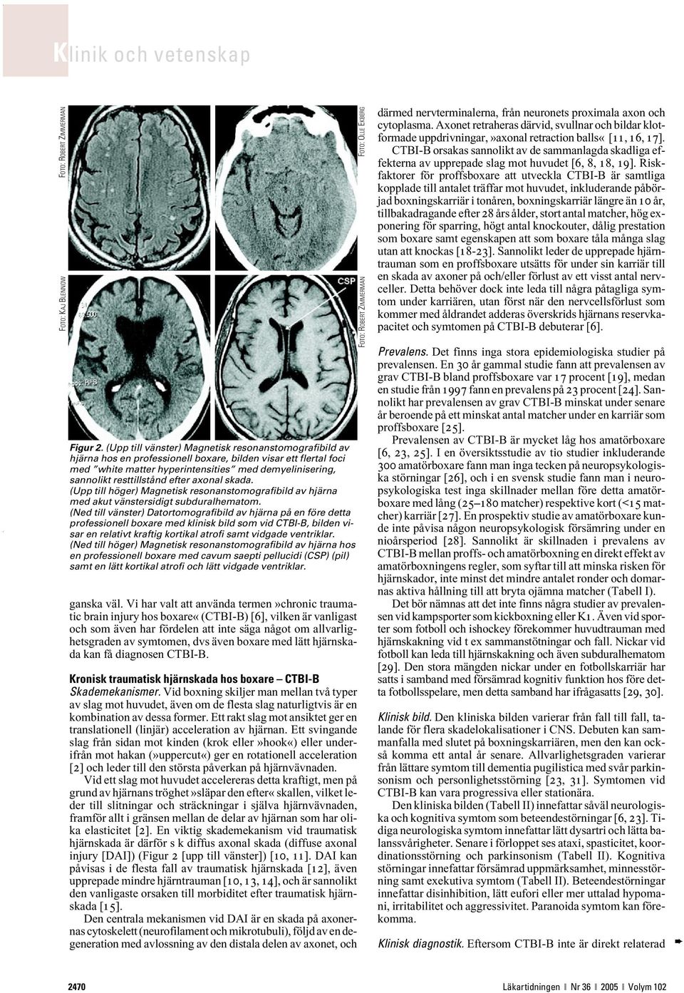 efter axonal skada. (Upp till höger) Magnetisk resonanstomografibild av hjärna med akut vänstersidigt subduralhematom.
