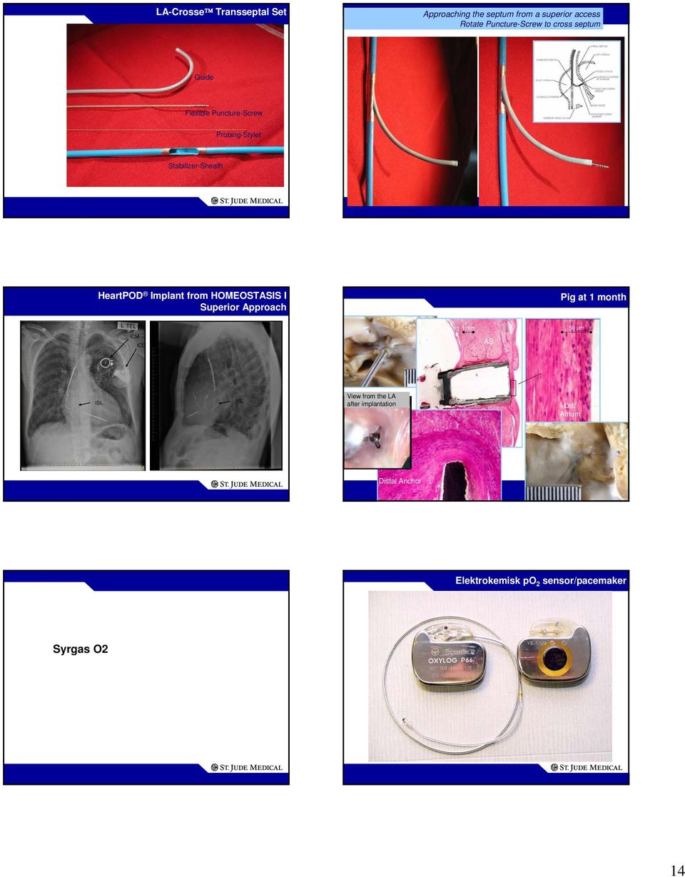 HOMEOSTASIS I Superior Approach Pig at 1 month ICM ICD Right Atrium 1 mm AS 50 um Sensor Module ISL