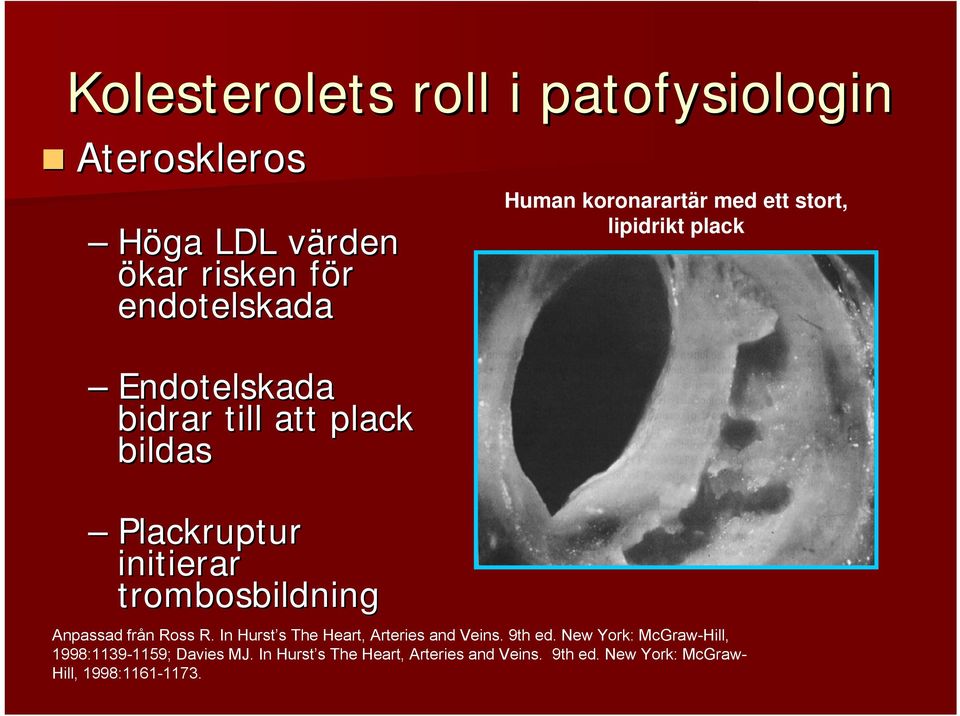 lipidrikt plack Anpassad från Ross R. In Hurst s The Heart, Arteries and Veins. 9th ed.