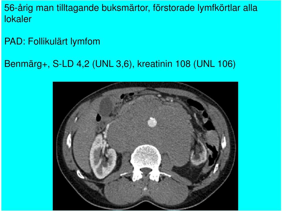 PAD: Follikulärt lymfom Benmärg+,
