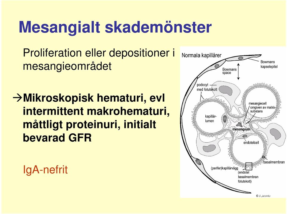 hematuri, evl intermittent makrohematuri,