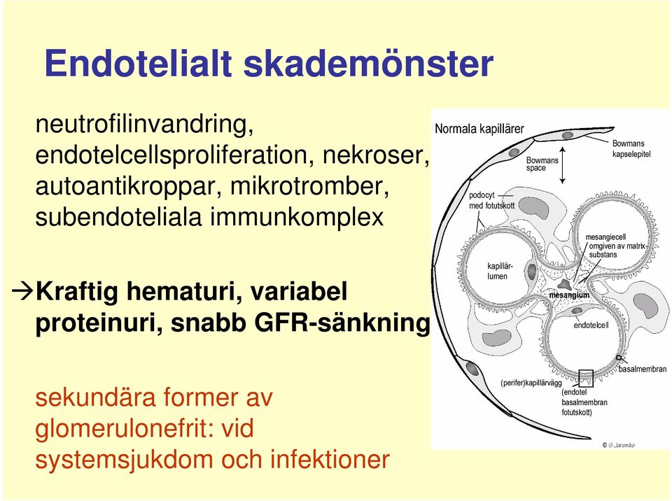 subendoteliala immunkomplex Kraftig hematuri, variabel proteinuri,