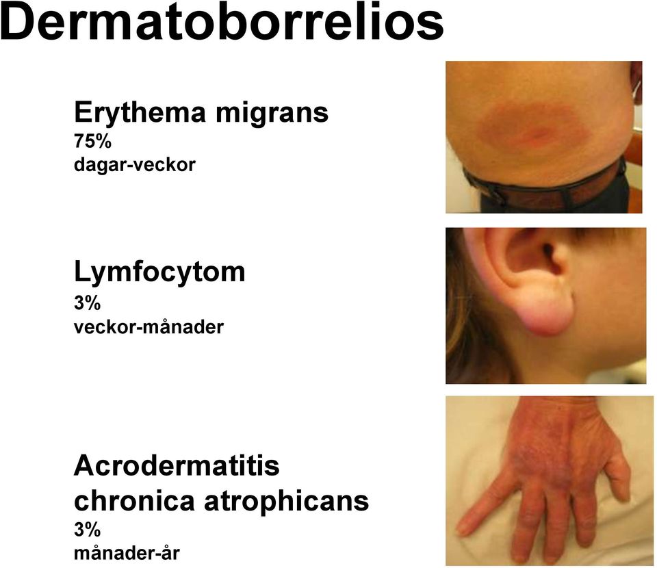 Lymfocytom 3% veckor-månader