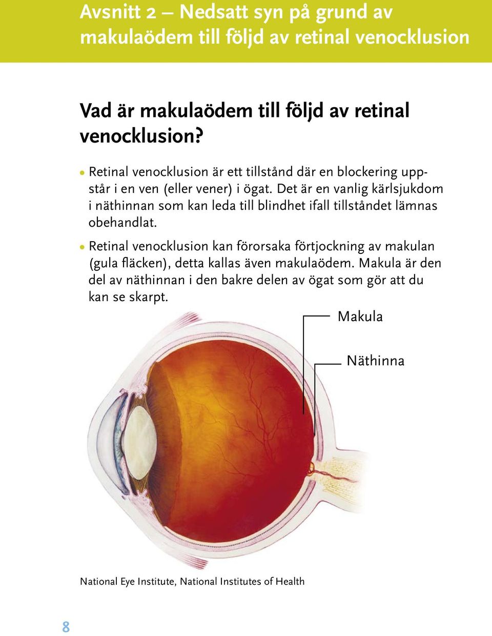 Det är en vanlig kärlsjukdom i näthinnan som kan leda till blindhet ifall tillståndet lämnas obehandlat.