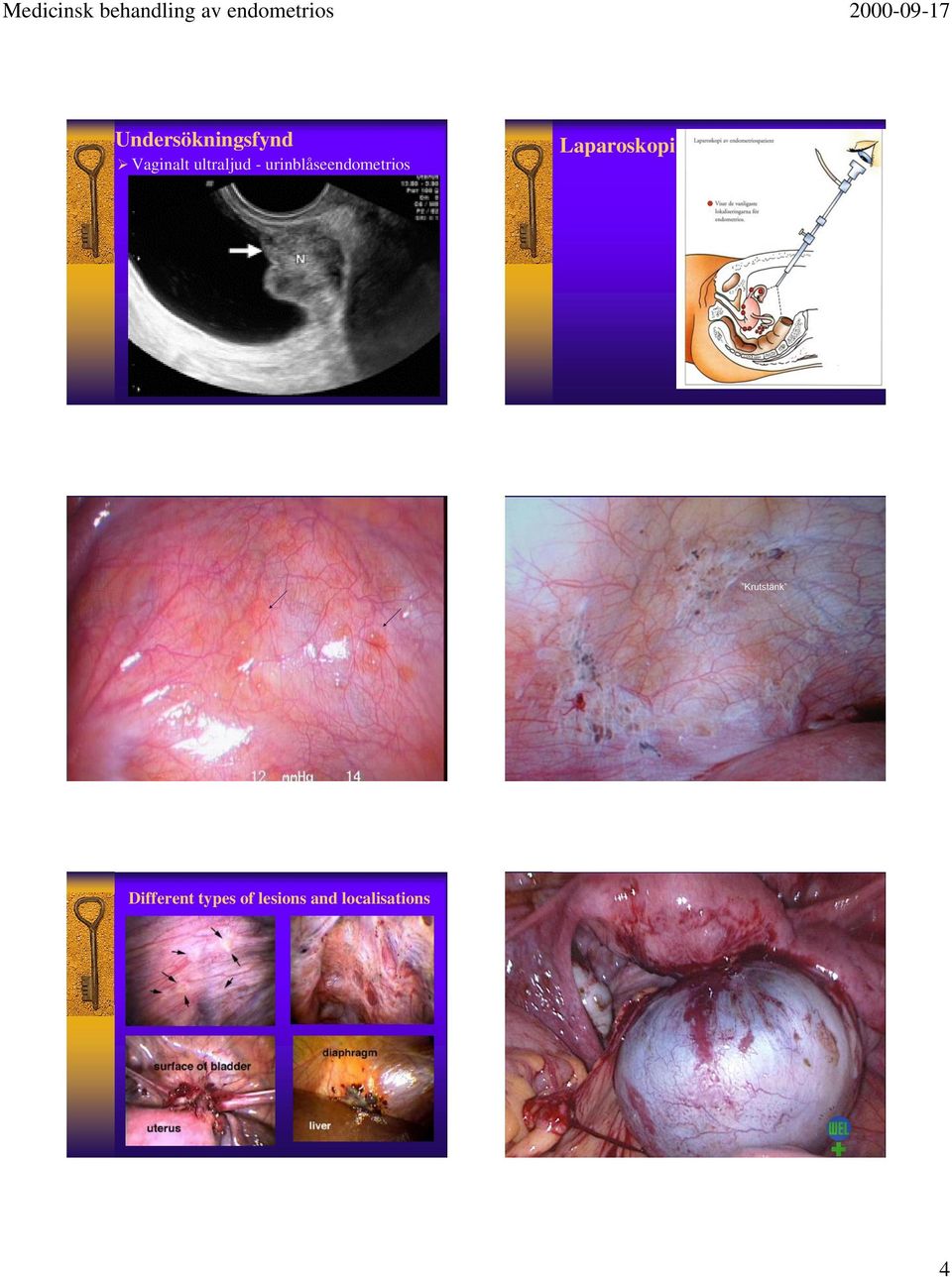 urinblåseendometrios