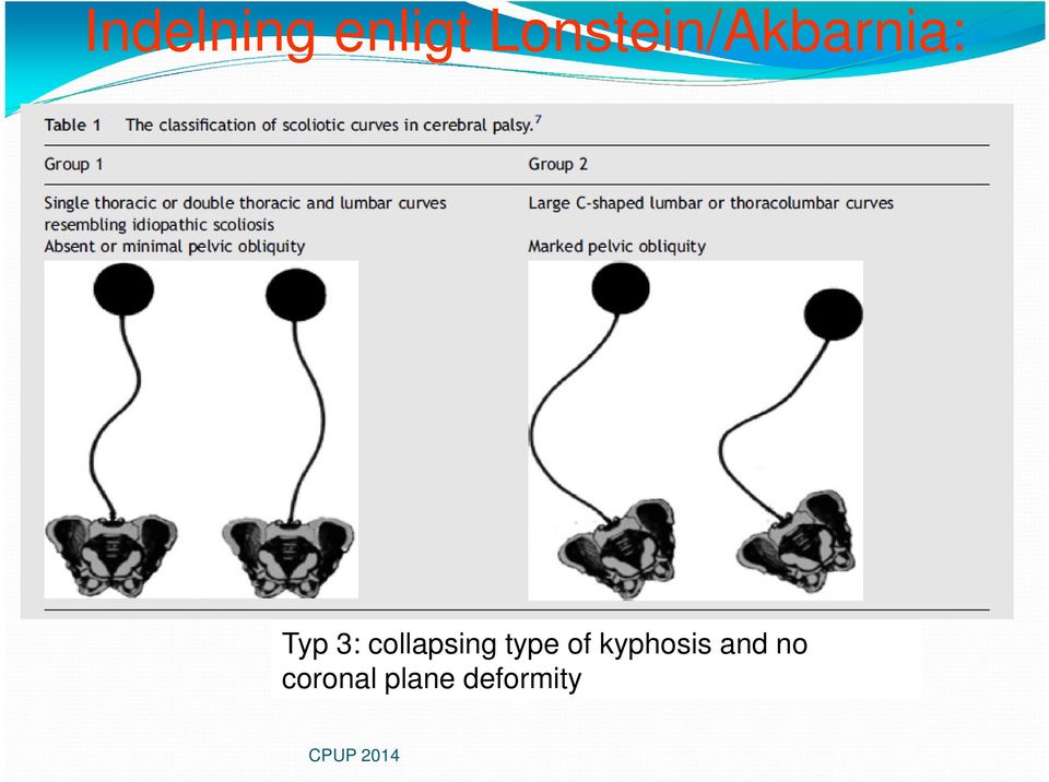 collapsing type of