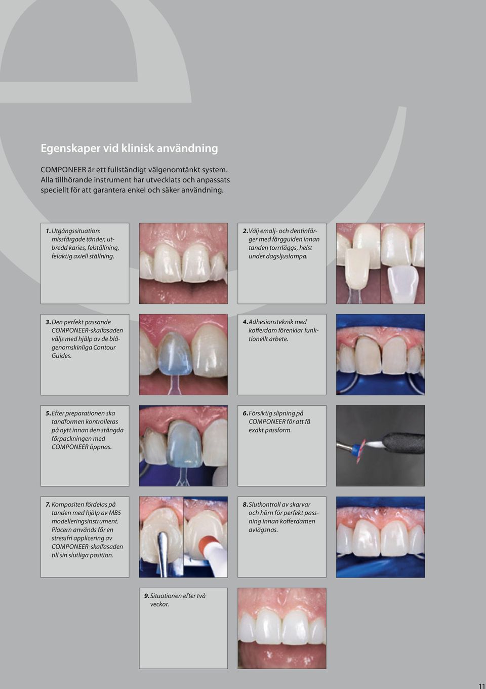 Den perfekt passande Componeer-skalfasaden väljs med hjälp av de blågenomskinliga Contour Guides. 4. Adhesionsteknik med kofferdam förenklar funktionellt arbete. 5.