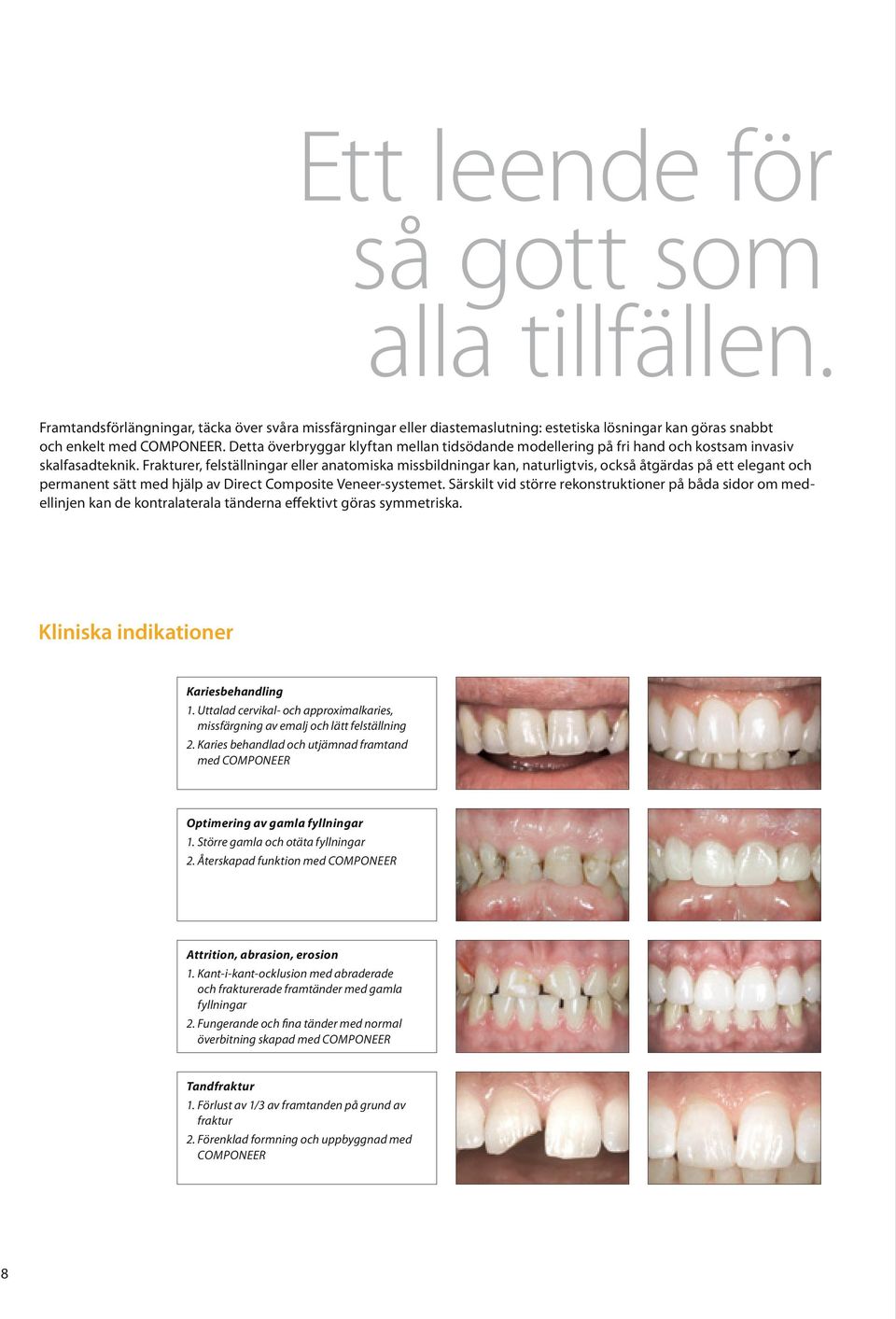 Frakturer, felställningar eller anatomiska missbildningar kan, naturligtvis, också åtgärdas på ett elegant och permanent sätt med hjälp av Direct Composite Veneer-systemet.