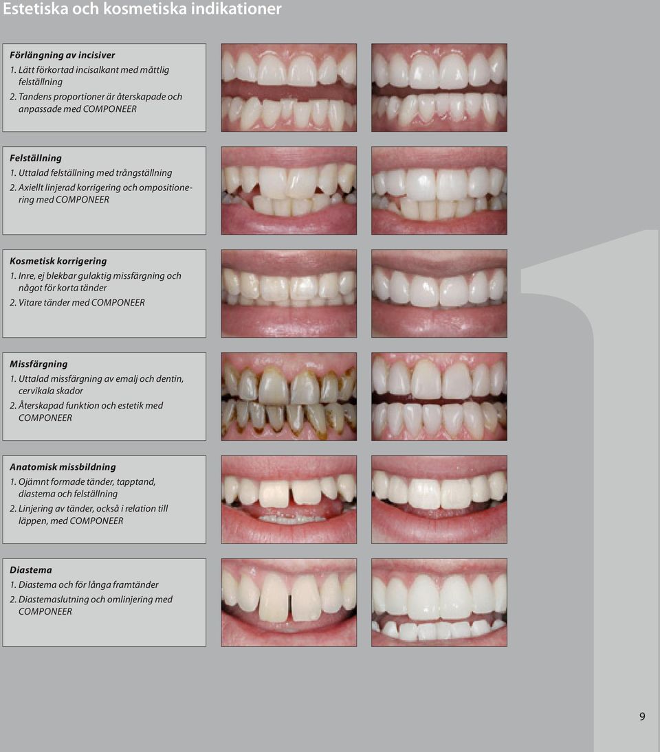 Vitare tänder med Componeer Missfärgning 1. Uttalad missfärgning av emalj och dentin, cervikala skador 2. Återskapad funktion och estetik med Componeer Anatomisk missbildning 1.