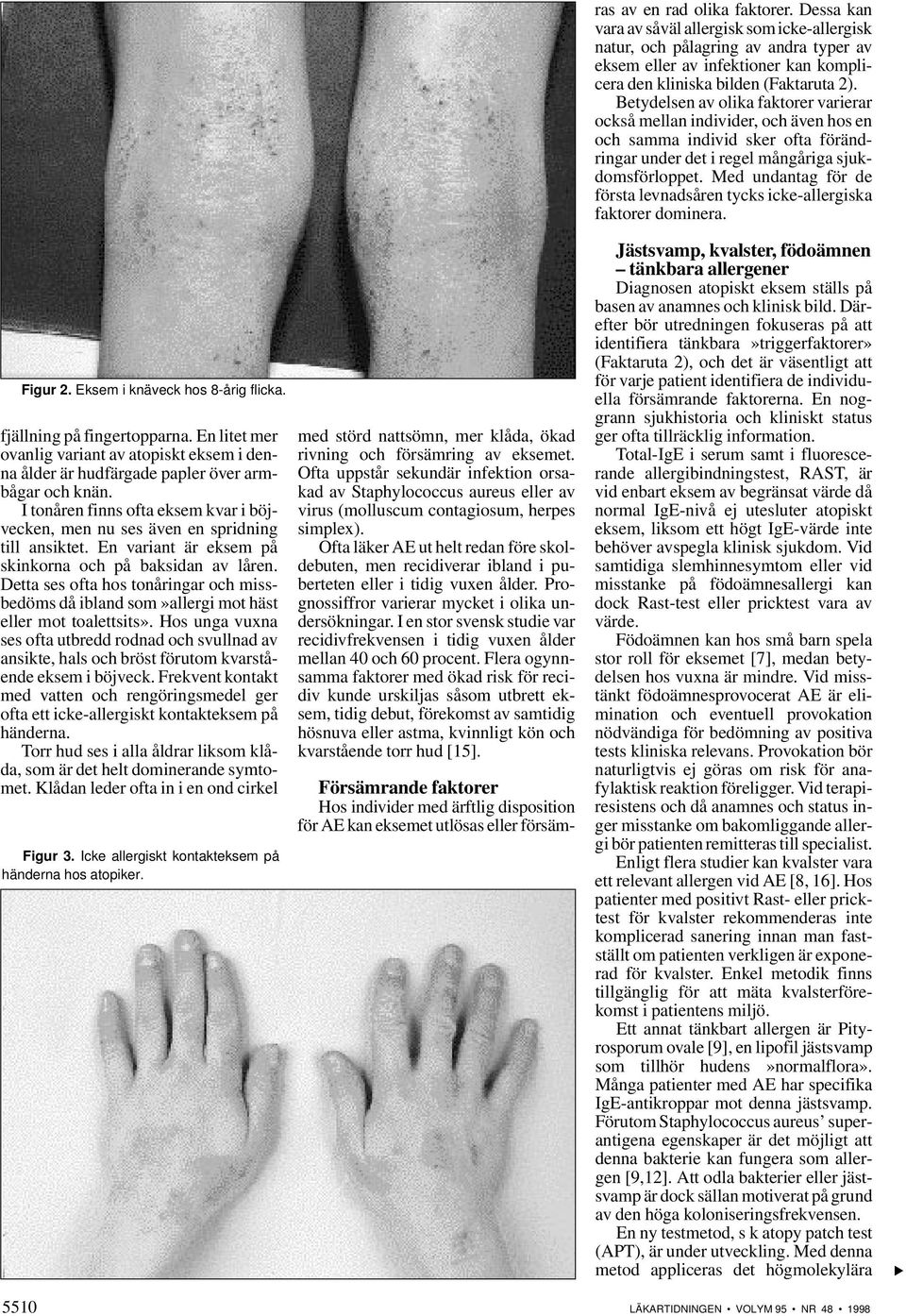 Med undantag för de första levnadsåren tycks icke-allergiska faktorer dominera. Figur 2. Eksem i knäveck hos 8-årig flicka. fjällning på fingertopparna.