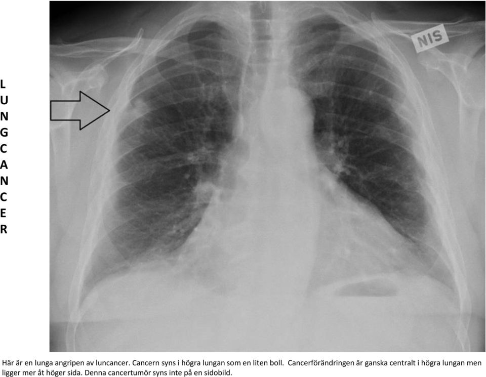 Cancerförändringen är ganska centralt i högra lungan men