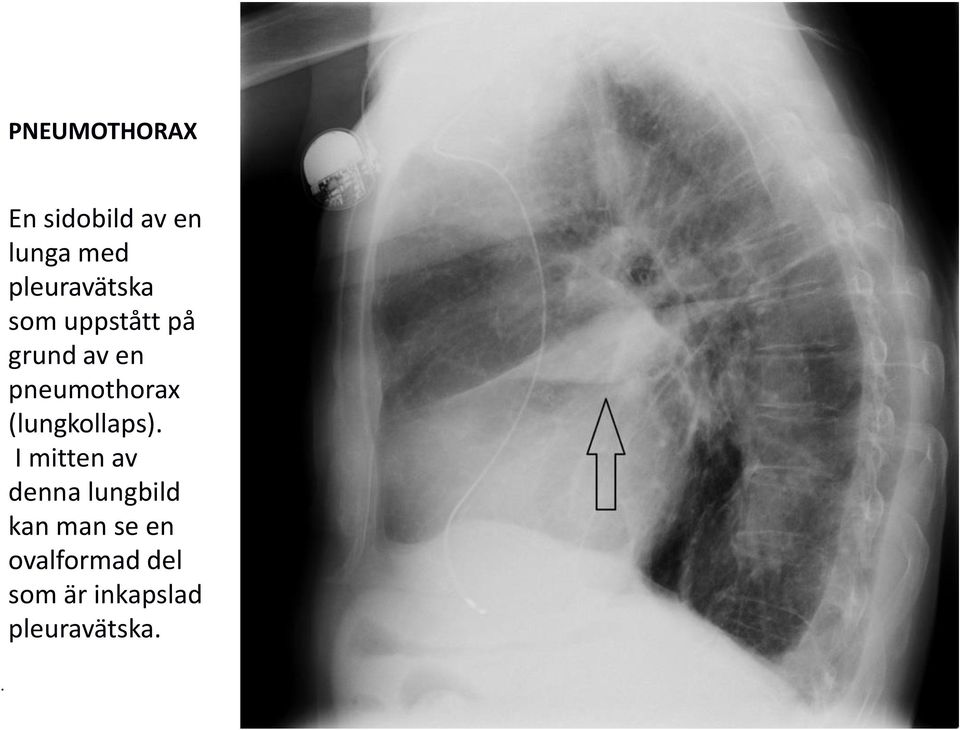 pneumothorax (lungkollaps).