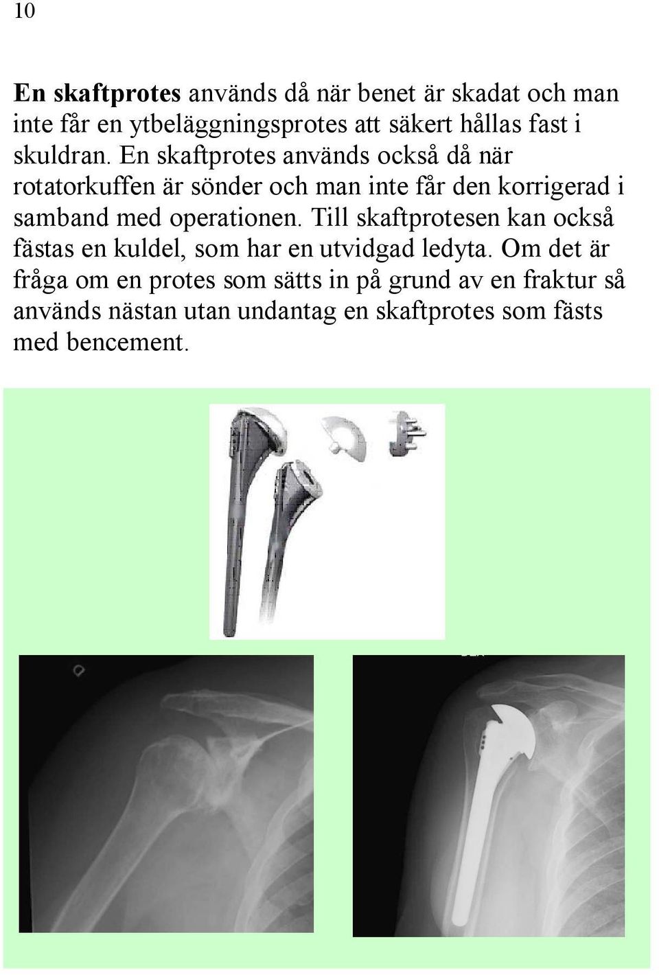 En skaftprotes används också då när rotatorkuffen är sönder och man inte får den korrigerad i samband med