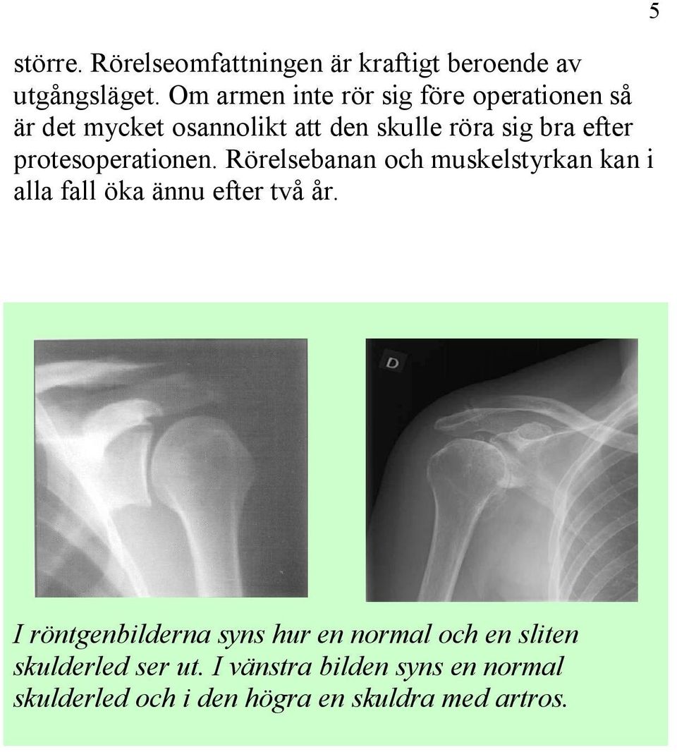 protesoperationen. Rörelsebanan och muskelstyrkan kan i alla fall öka ännu efter två år.