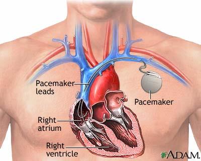Pacemaker