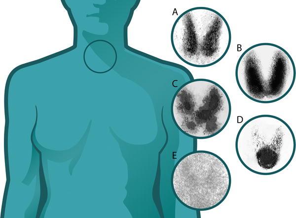 99 Tc-Scintigrafi-morfologi (A) Normal. (B) Graves disease: diffuse increased uptake in both thyroid lobes.