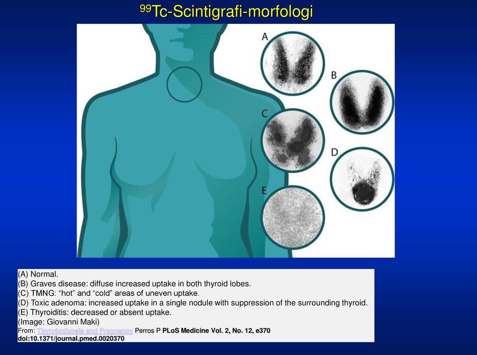 (D) Toxic adenoma: increased uptake in a single nodule with suppression of the surrounding thyroid.