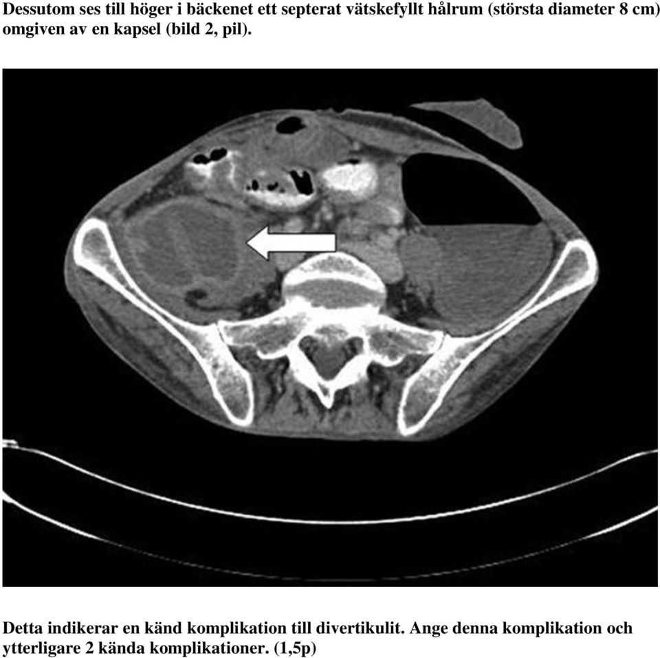 pil). Detta indikerar en känd komplikation till divertikulit.