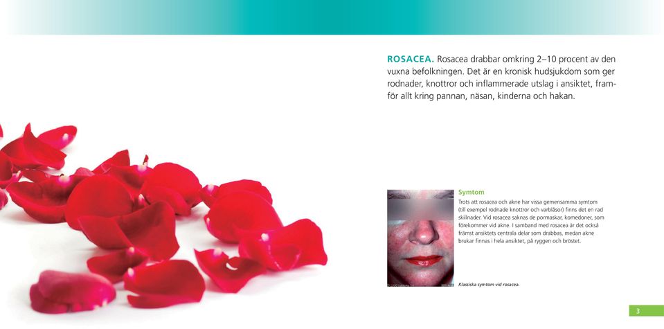 Symtom Trots att rosacea och akne har vissa gemensamma symtom (till exempel rodnade knottror och varblåsor) finns det en rad skillnader.