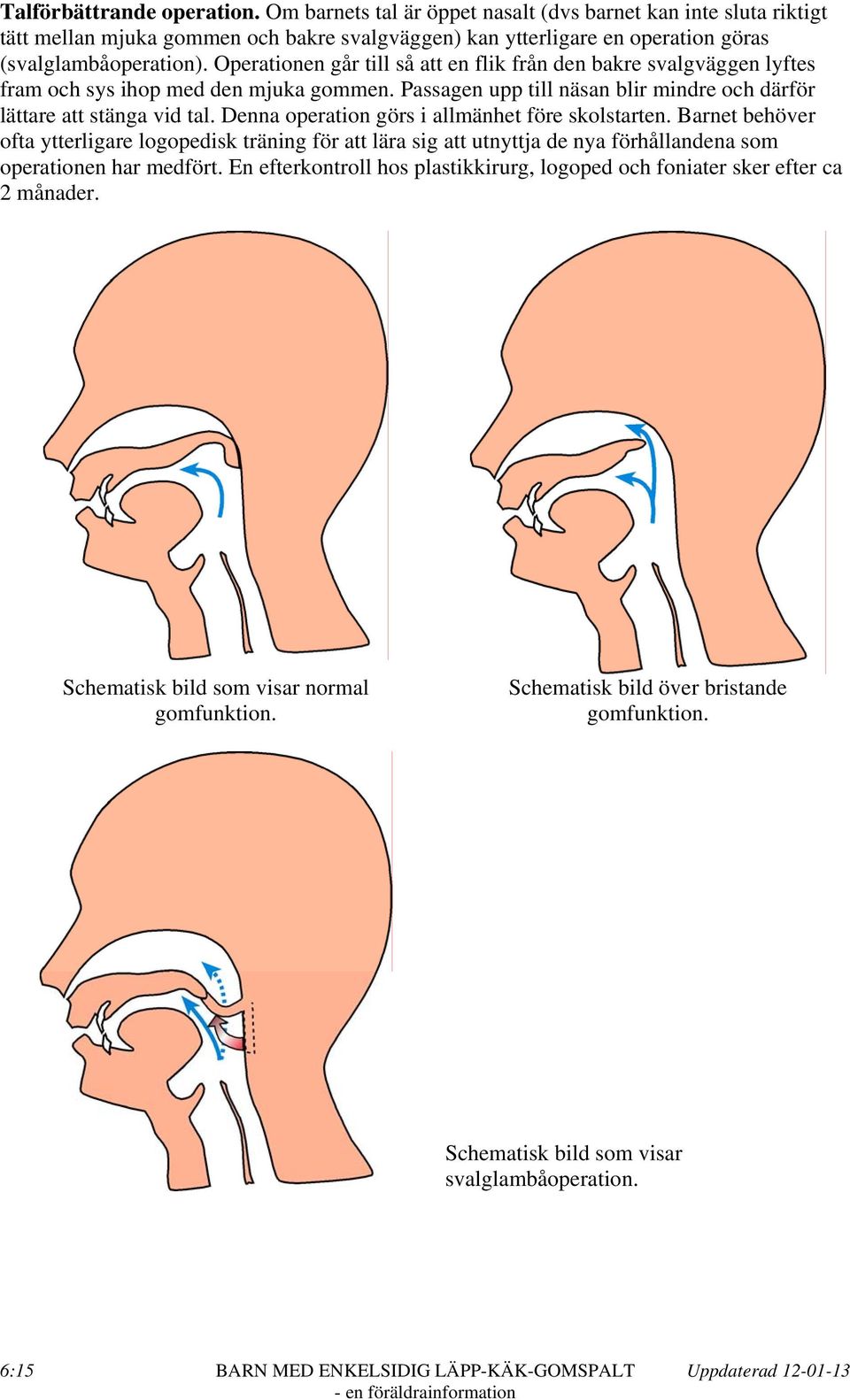 Denna operation görs i allmänhet före skolstarten. Barnet behöver ofta ytterligare logopedisk träning för att lära sig att utnyttja de nya förhållandena som operationen har medfört.