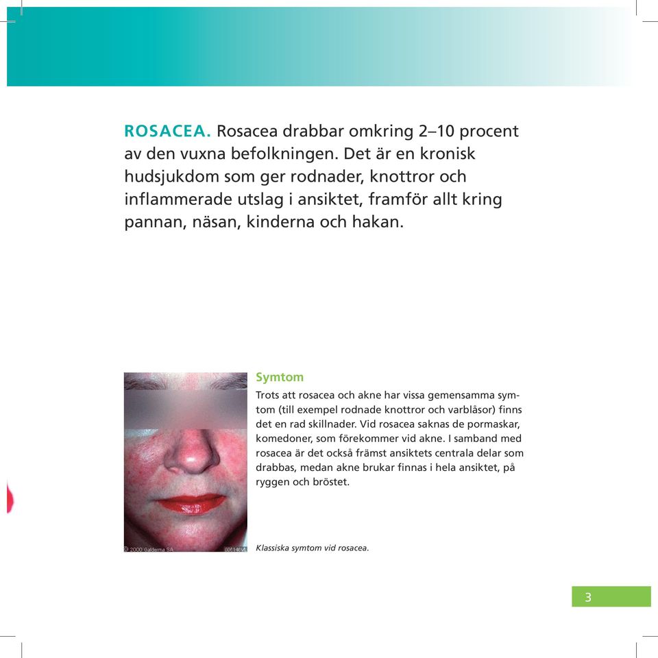 Symtom Trots att rosacea och akne har vissa gemensamma symtom (till exempel rodnade knottror och varblåsor) finns det en rad skillnader.