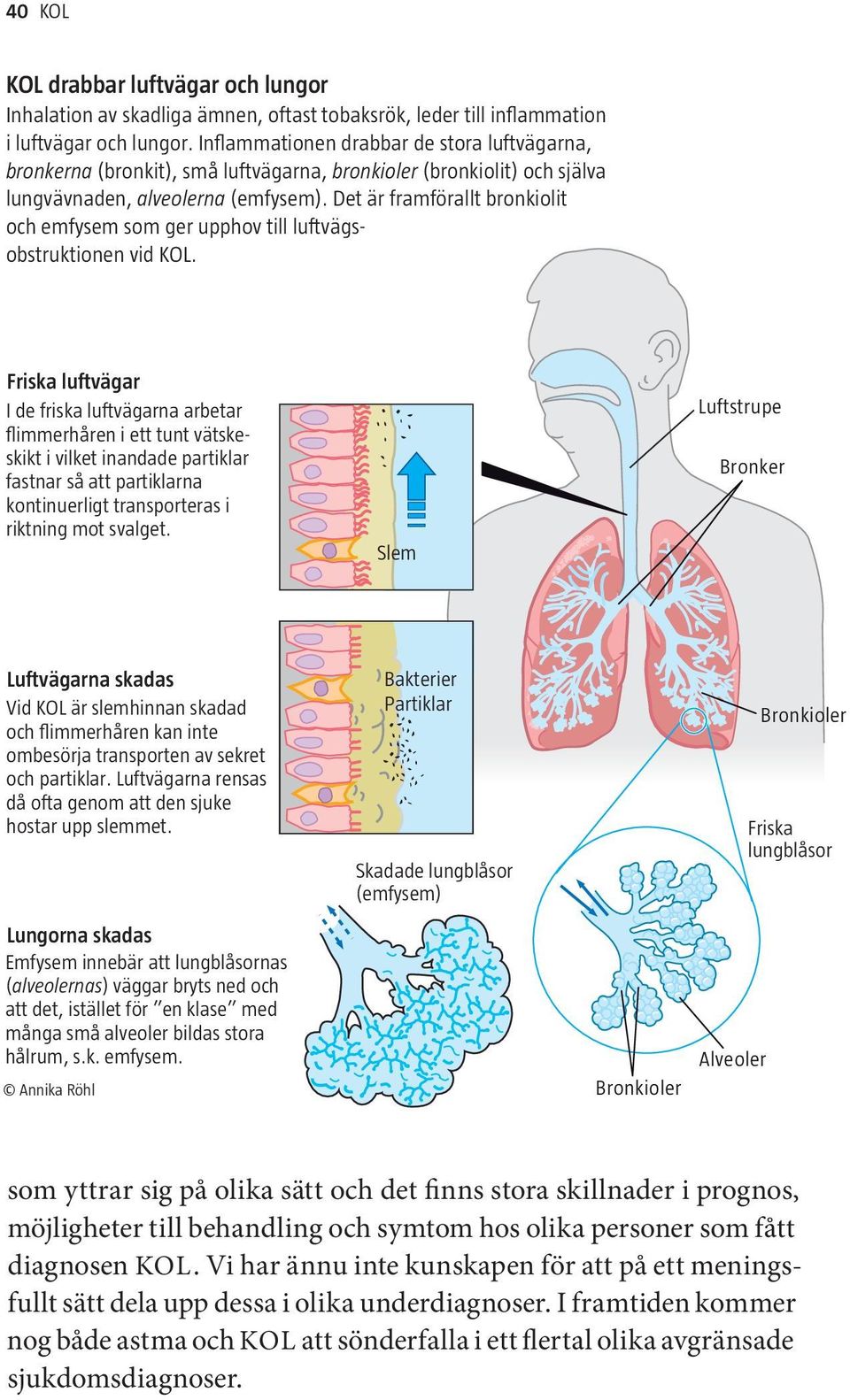 Det är framförallt bronkiolit och emfysem som ger upphov till luftvägsobstruktionen vid KOL.