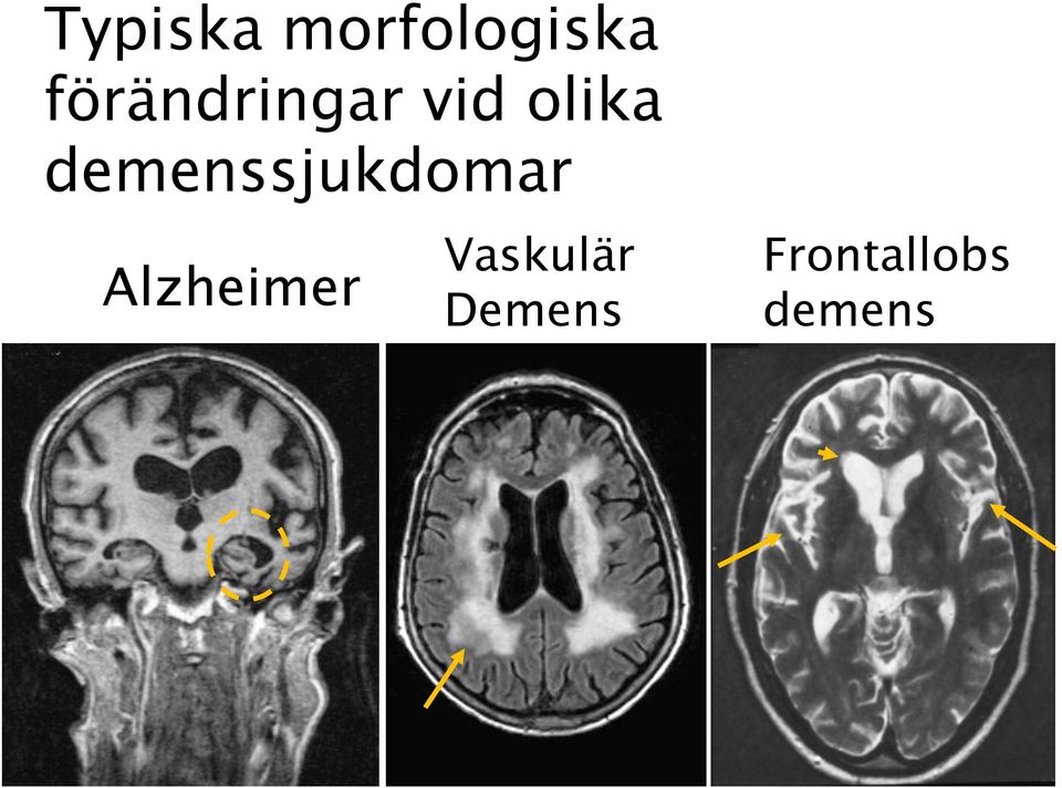 demenssjukdomar Alzheimer