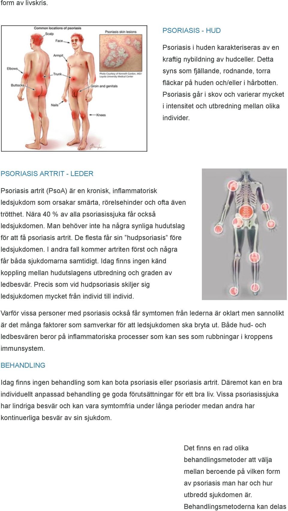 PSORIASIS ARTRIT - LEDER Psoriasis artrit (PsoA) är en kronisk, inflammatorisk ledsjukdom som orsakar smärta, rörelsehinder och ofta även trötthet.