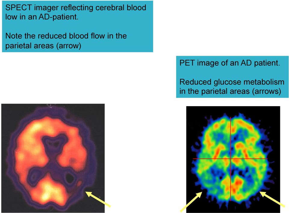 Note the reduced blood flow in the parietal areas