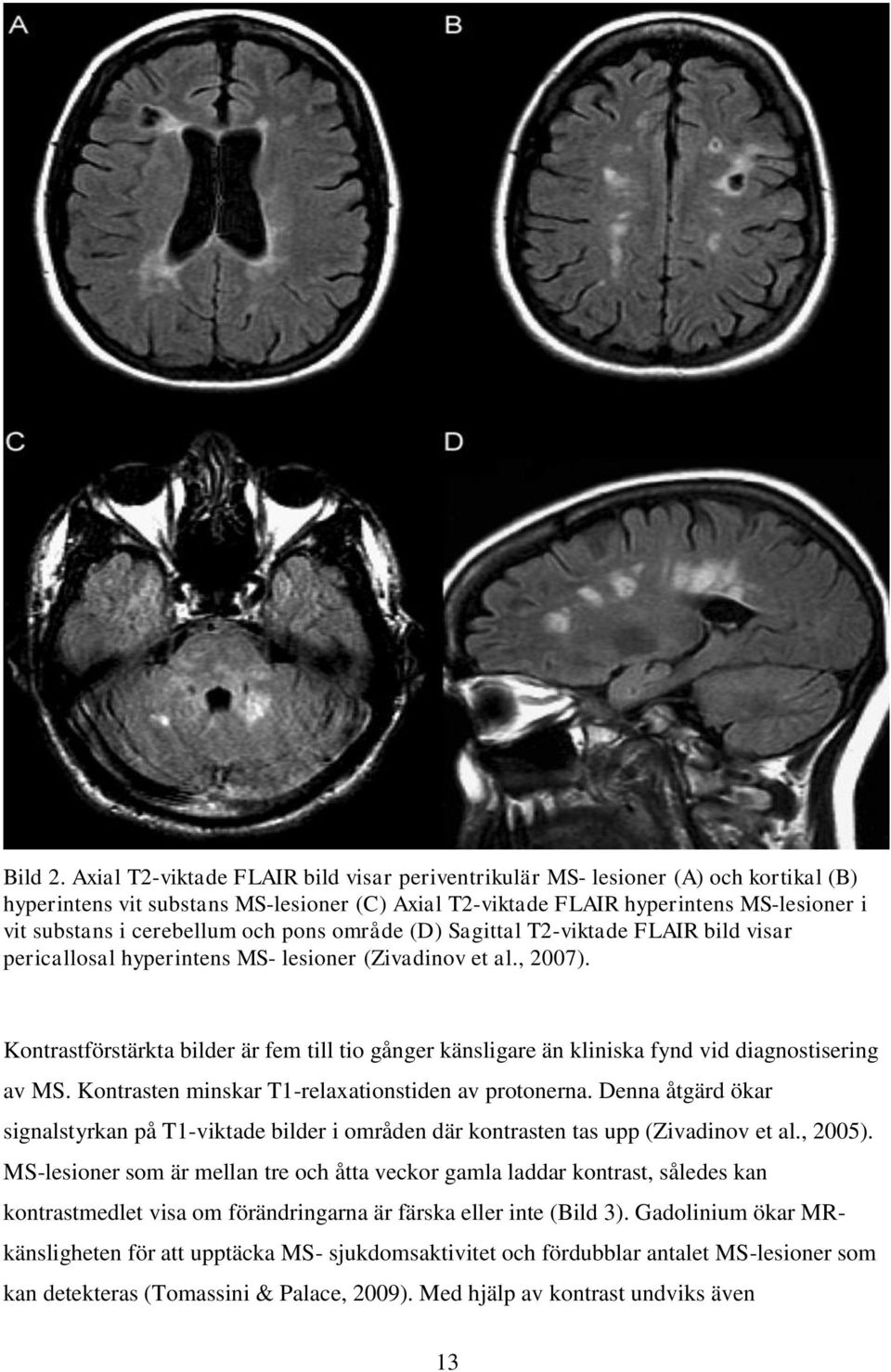 och pons område (D) Sagittal T2-viktade FLAIR bild visar pericallosal hyperintens MS- lesioner (Zivadinov et al., 2007).