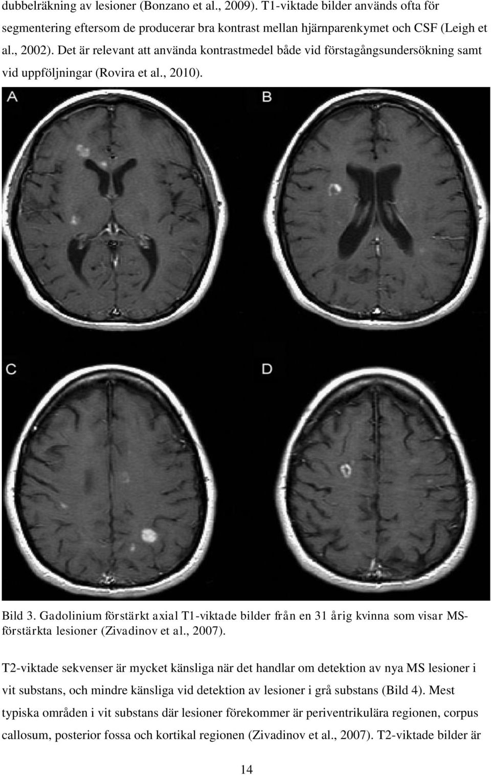 Gadolinium förstärkt axial T1-viktade bilder från en 31 årig kvinna som visar MSförstärkta lesioner (Zivadinov et al., 2007).