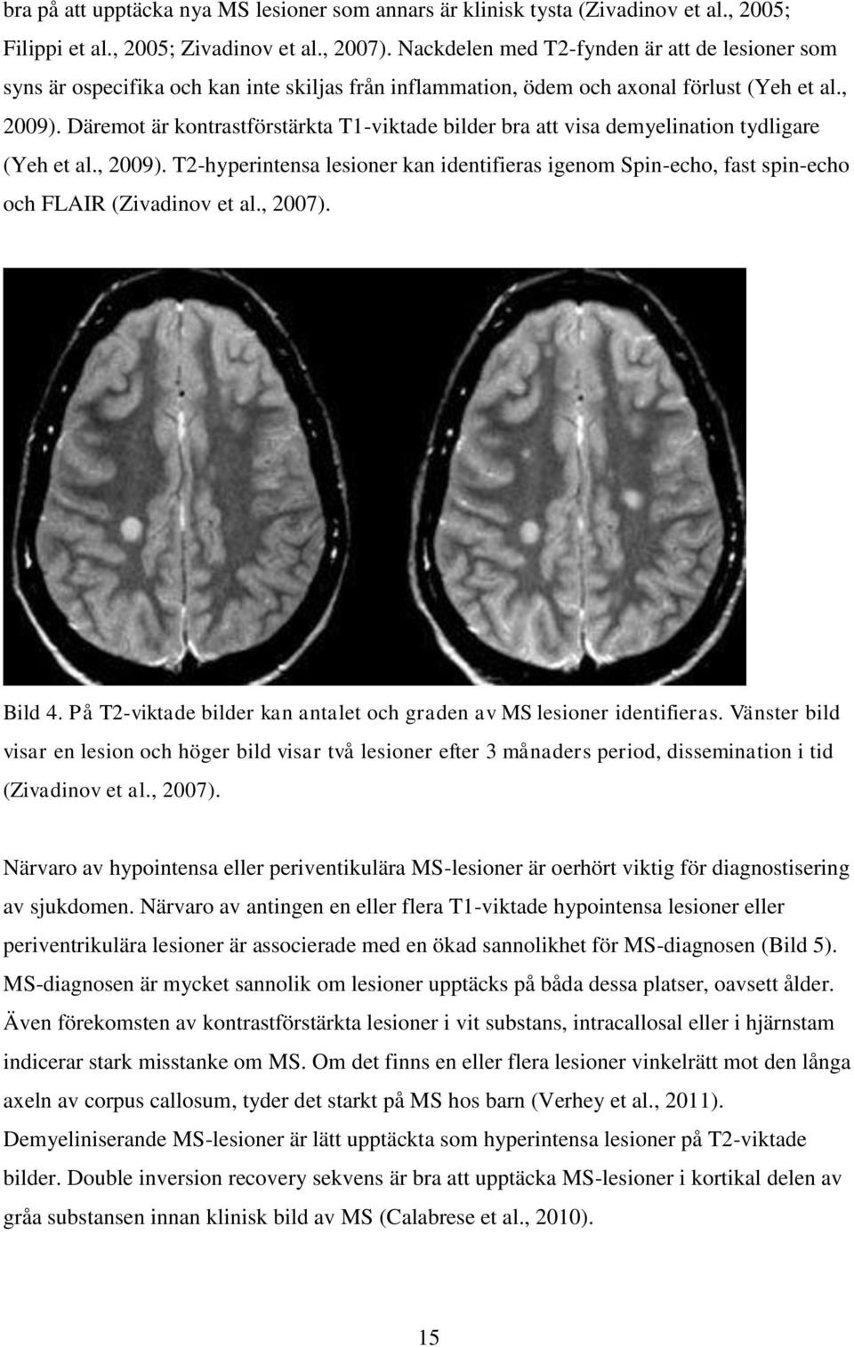 Däremot är kontrastförstärkta T1-viktade bilder bra att visa demyelination tydligare (Yeh et al., 2009).