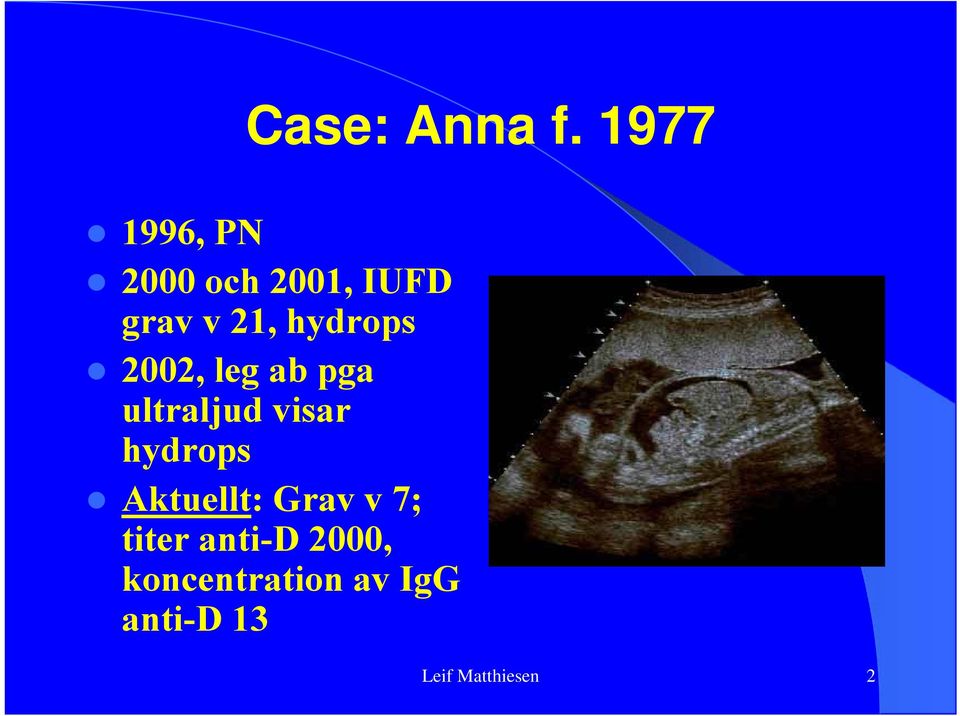 hydrops 2002, leg ab pga ultraljud visar hydrops