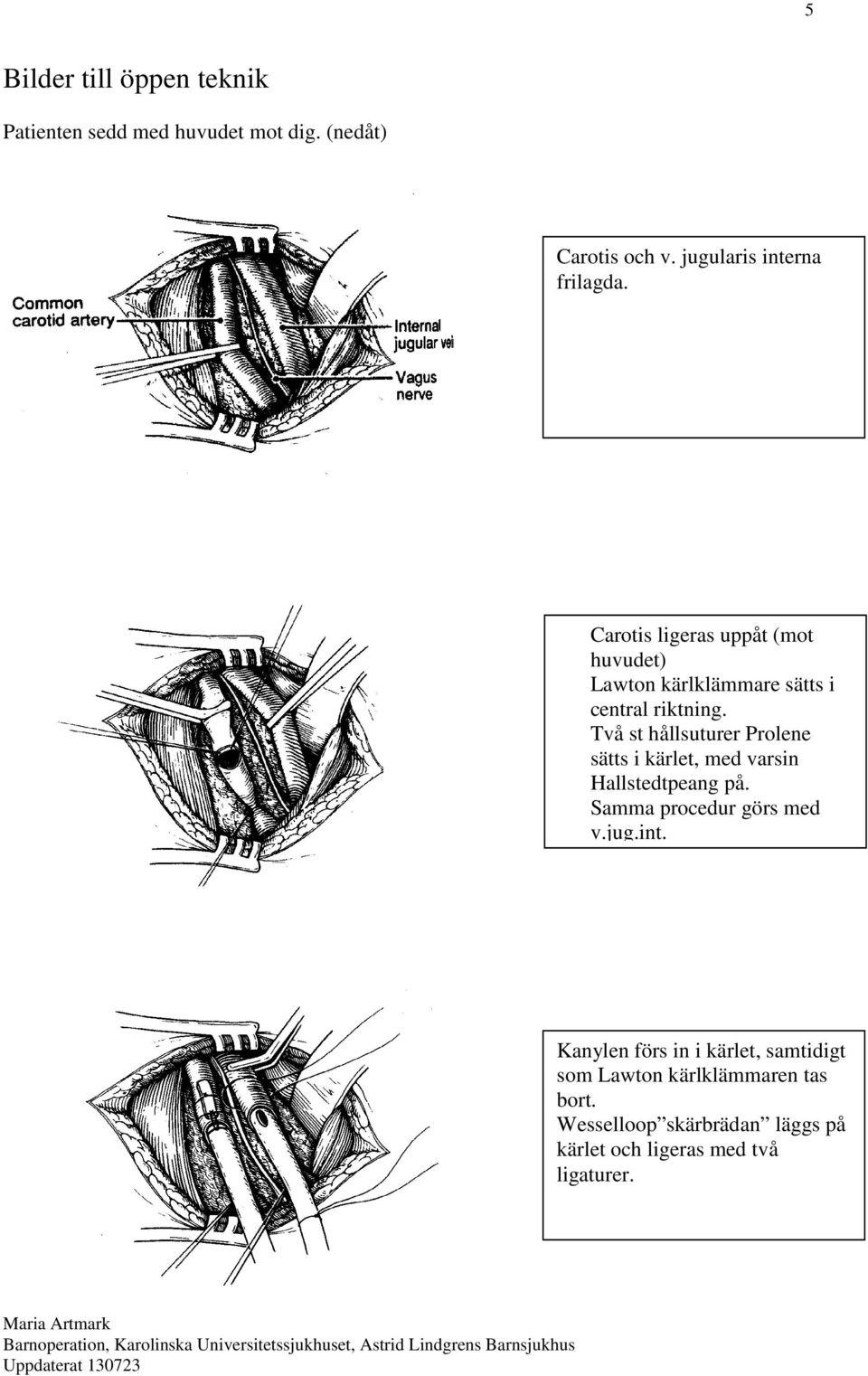 Två st hållsuturer Prolene sätts i kärlet, med varsin Hallstedtpeang på. Samma procedur görs med v.jug.int.