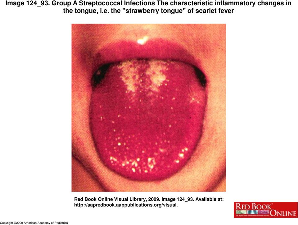 the tongue, i.e. the "strawberry tongue" of scarlet fever Red Book Online