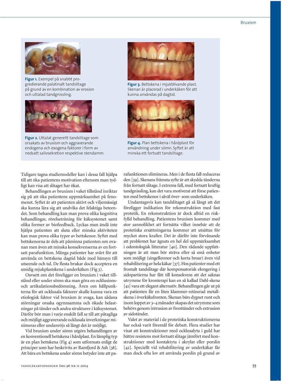 Uttalat generellt tandslitage som orsakats av bruxism och aggraverande endogena och exogena faktorer i form av nedsatt salivsekretion respektive stendamm. Figur 4.