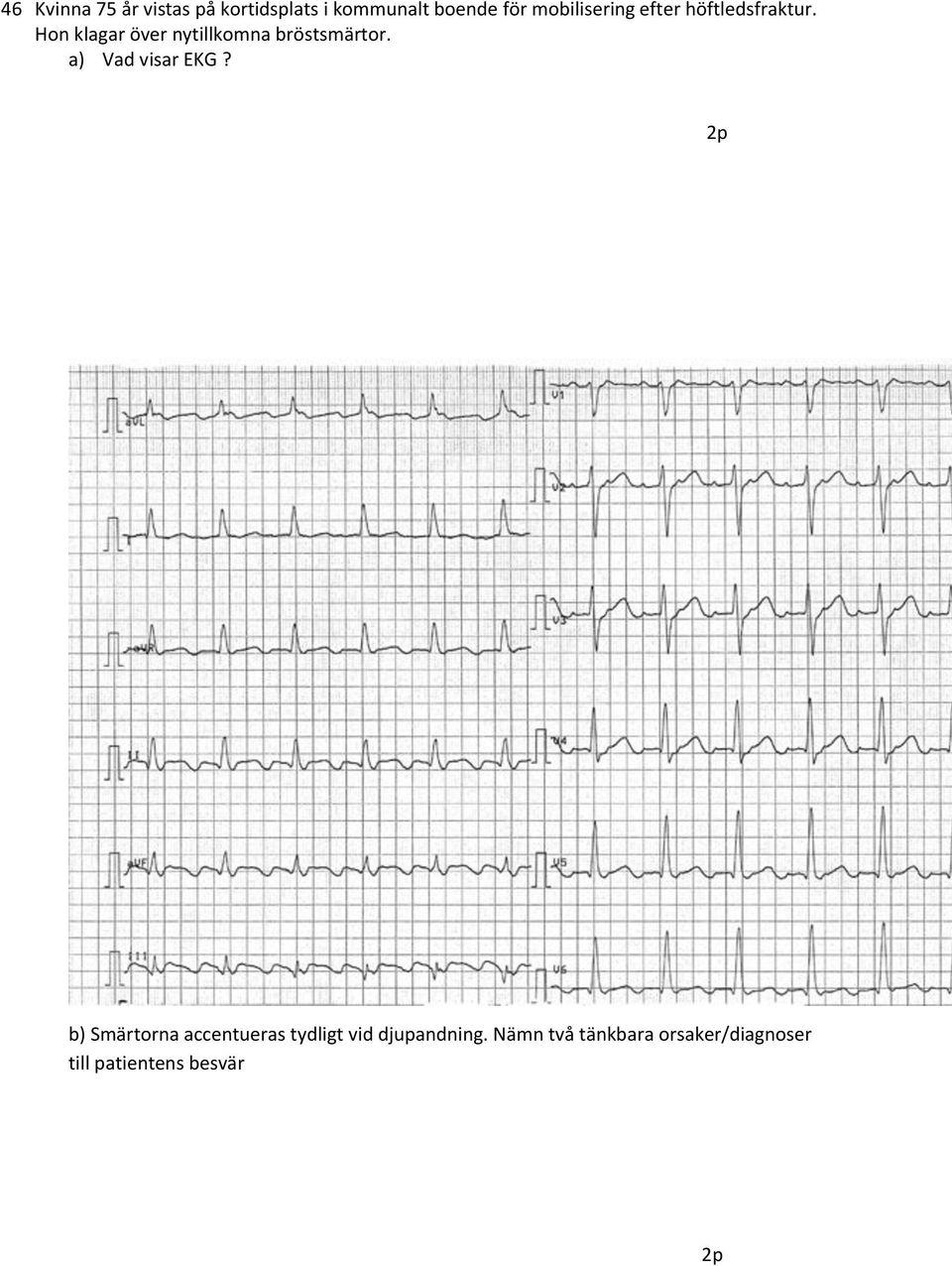 Hon klagar över nytillkomna bröstsmärtor. a) Vad visar EKG?