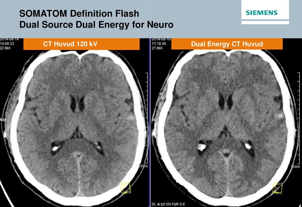 Energy for Neuro CT