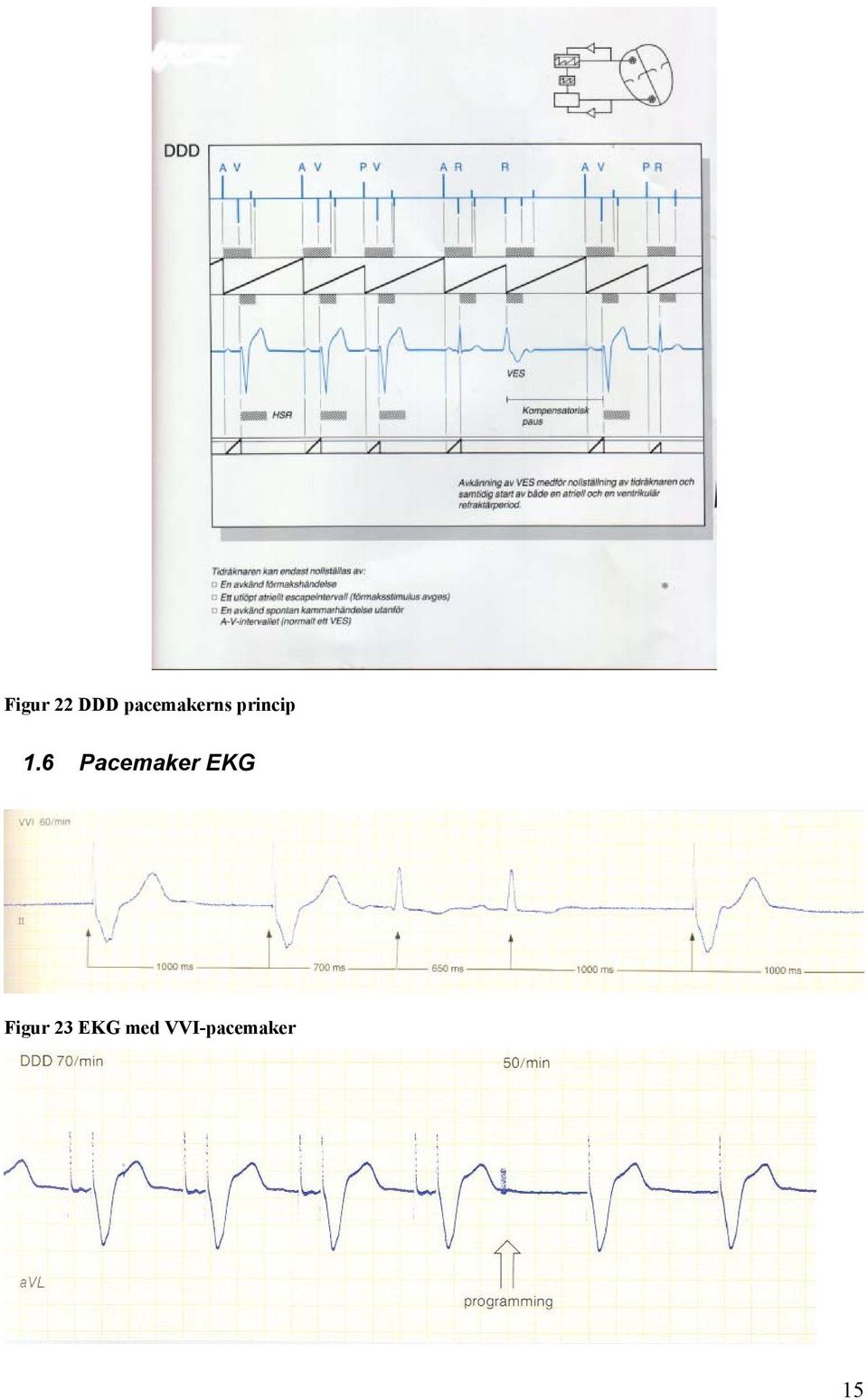 1.6 Pacemaker EKG