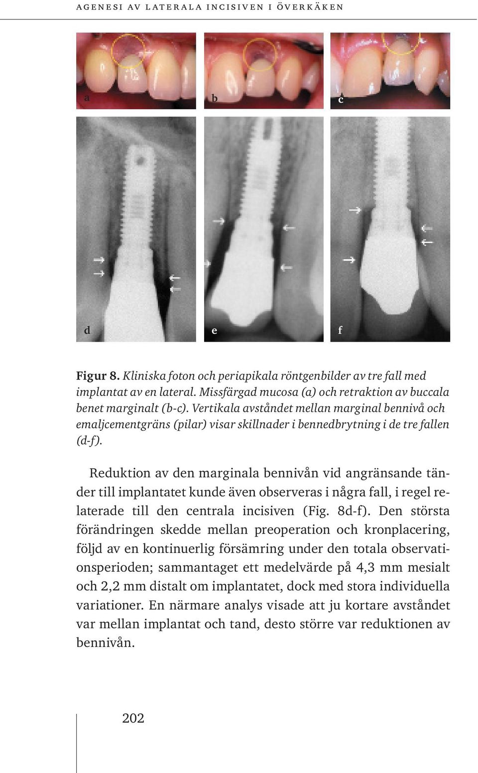 Reduktion av den marginala bennivån vid angränsande tänder till implantatet kunde även observeras i några fall, i regel relaterade till den centrala incisiven (Fig. 8d-f).