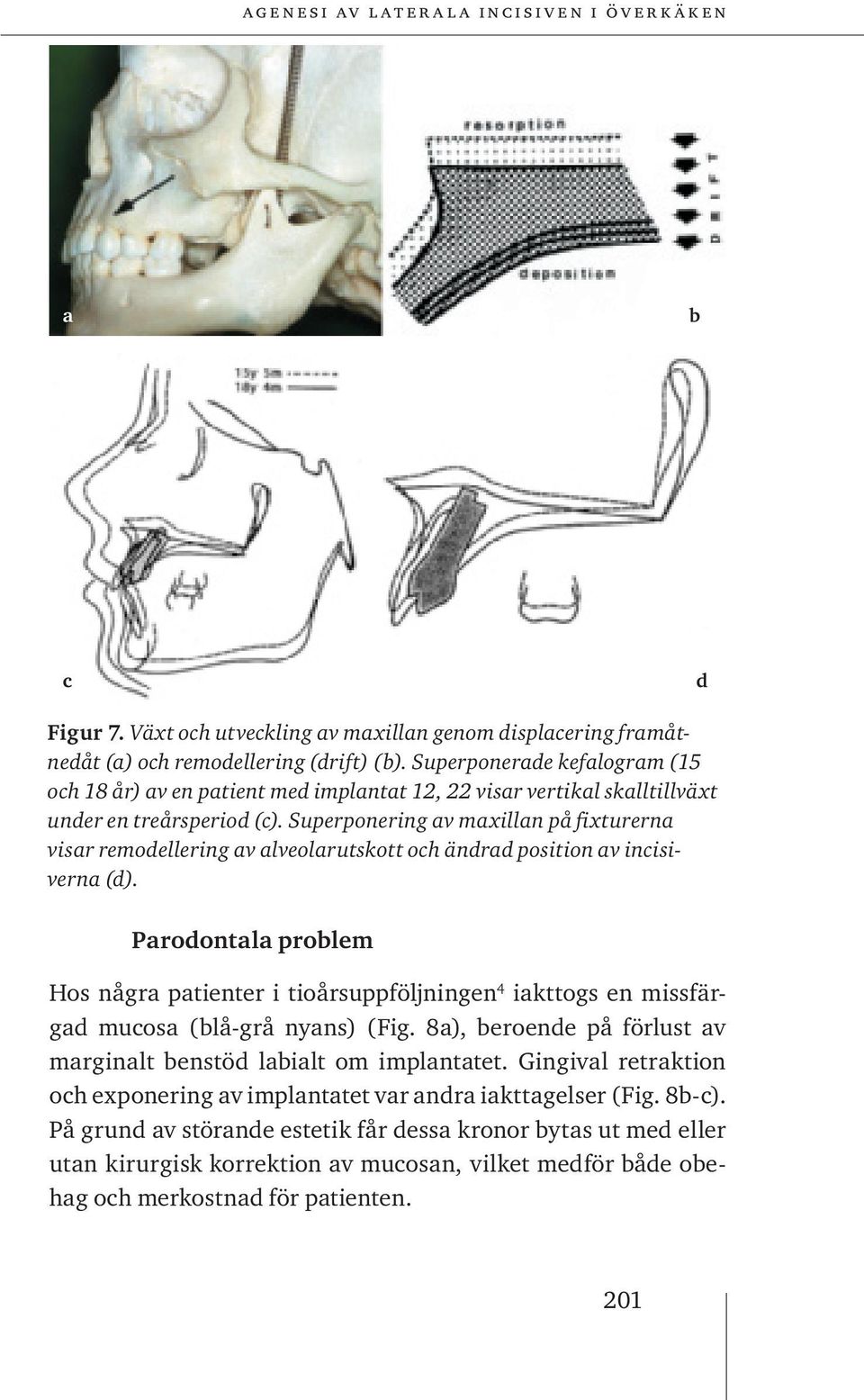 Superponering av maxillan på fixturerna visar remodellering av alveolarutskott och ändrad position av incisiverna (d).