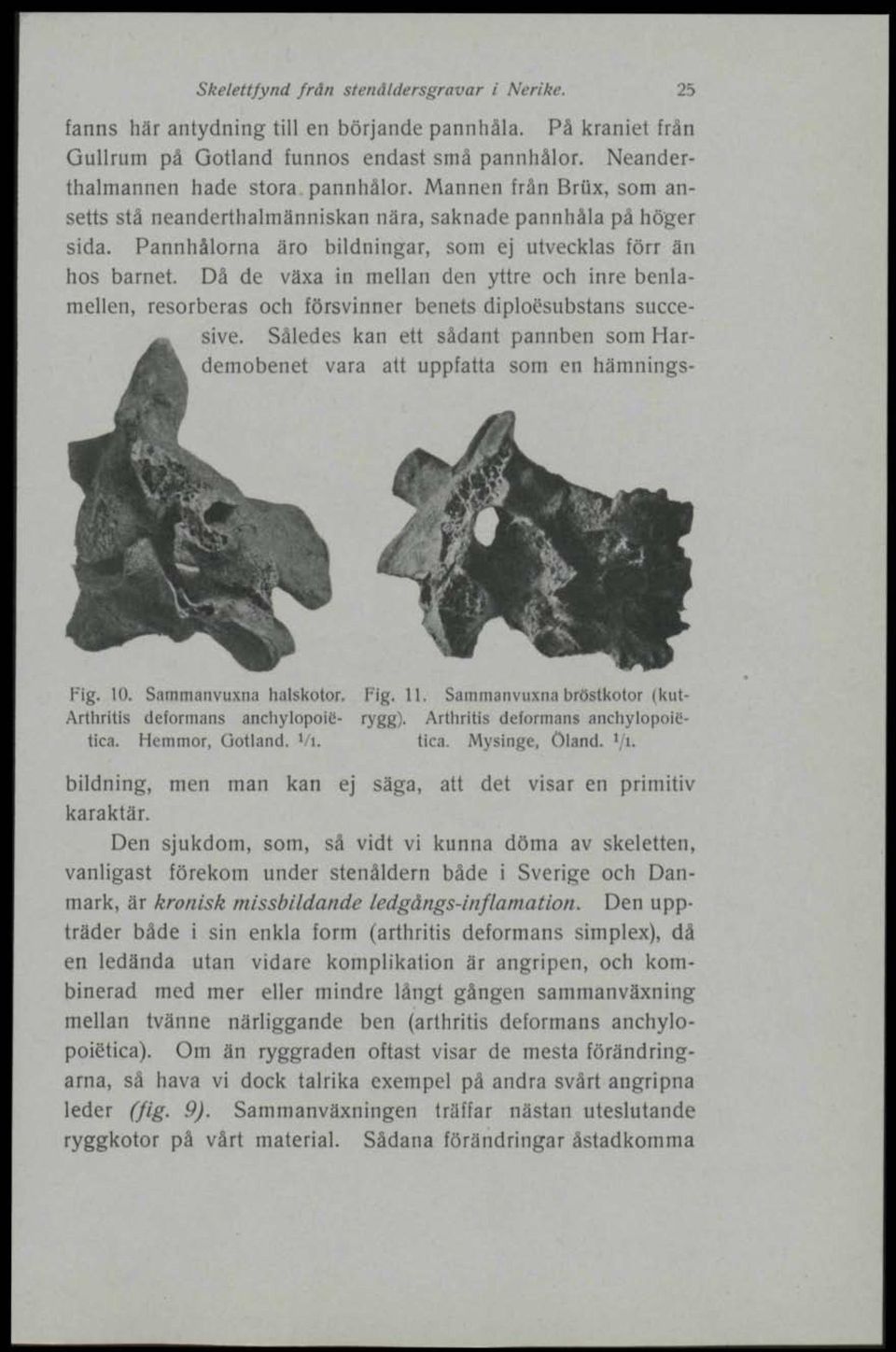 Då de växa in mellan den yttre och inre benlamellen, resorberas och försvinner benets diploésubstans succesive. Således kan ett sådant pannben som Hardemobenet vara att uppfatta som en hämnings- Fig.
