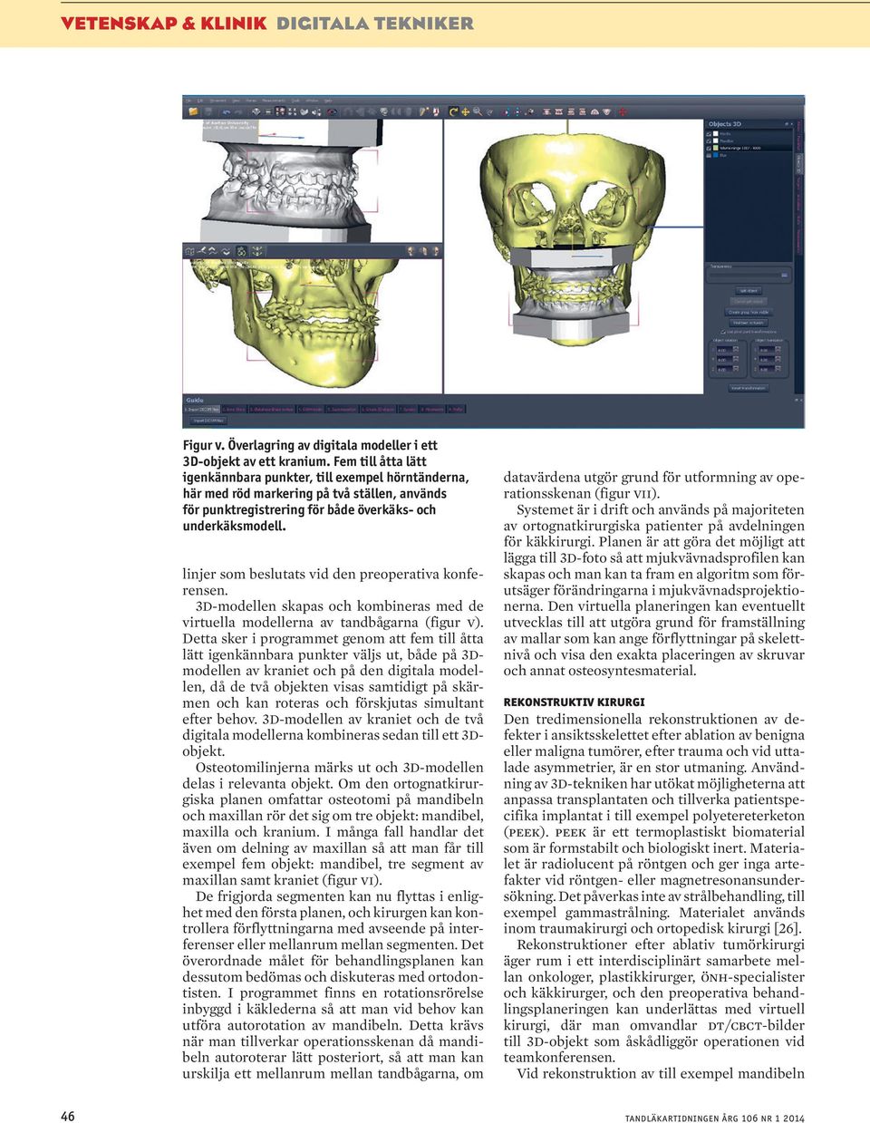 linjer som beslutats vid den preoperativa konferensen. 3D-modellen skapas och kombineras med de virtuella modellerna av tandbågarna (figur v).