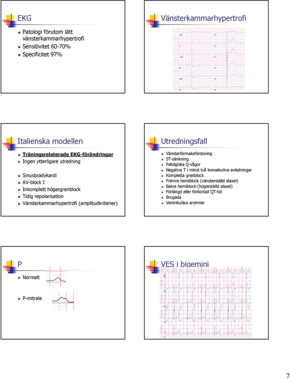 (amplitudkriterier) Utredningsfall Vänsterförmaksförstoring ST-sänkning Patolgiska Q-vågor Negativa T i minst två konsekutiva avledningar Kompletta