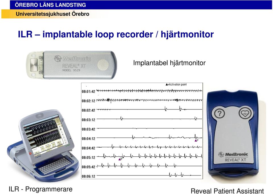 Implantabel hjärtmonitor ILR