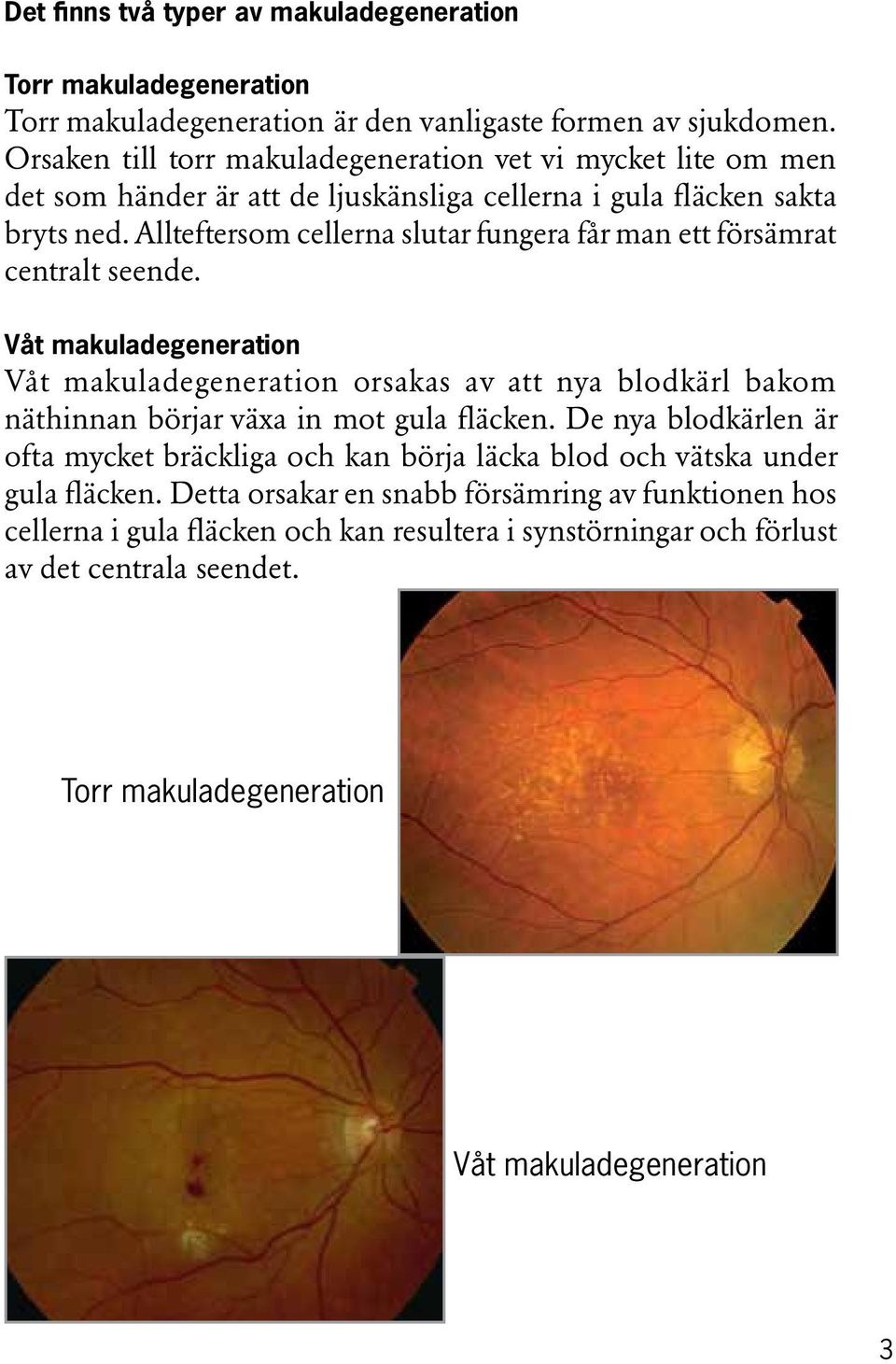 Allteftersom cellerna slutar fungera får man ett försämrat centralt seende.