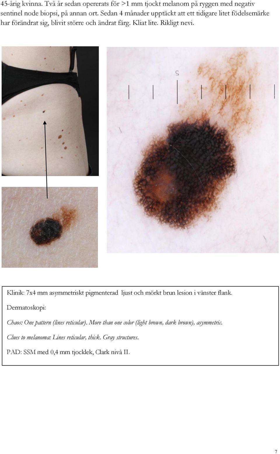 Klinik: 7x4 mm asymmetriskt pigmenterad ljust och mörkt brun lesion i vänster flank. Chaos: One pattern (lines reticular).