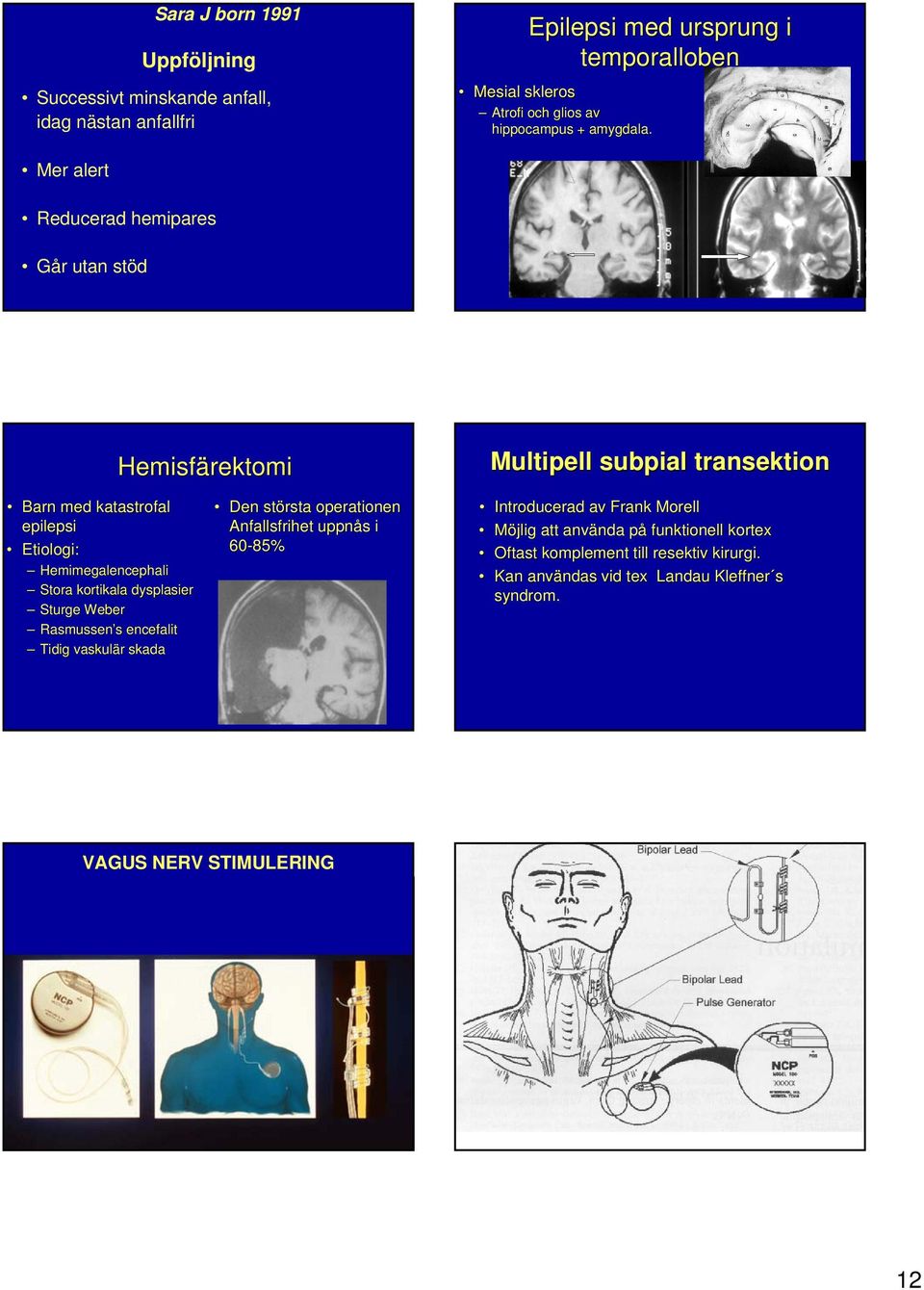 Mer alert Reducerad hemipares Går utan stöd Hemisfärektomi Multipell subpial transektion Barn med katastrofal epilepsi Etiologi: Hemimegalencephali Stora