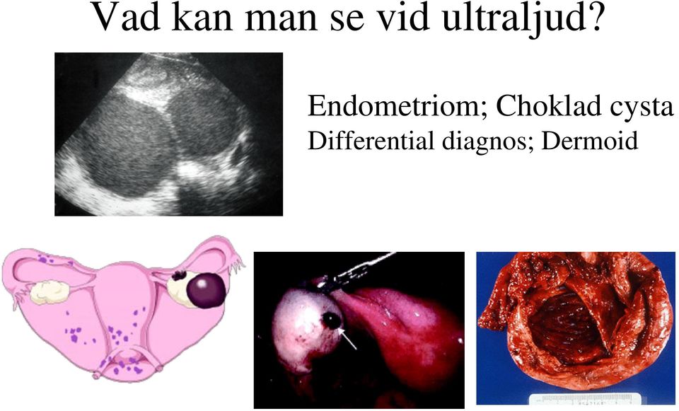 Endometriom; Choklad